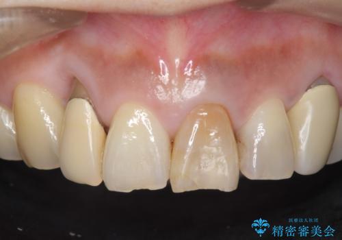 オールセラミッククラウン 下がってしまった前歯の歯茎の改善の治療前