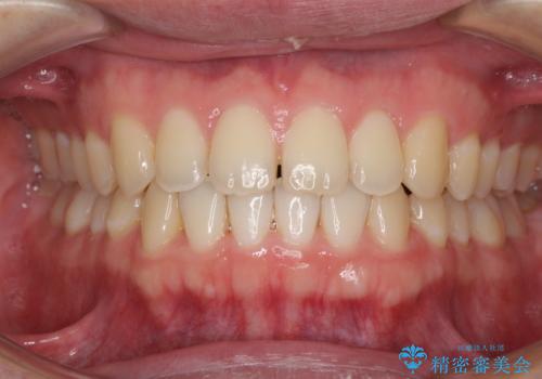 すきっ歯の改善　インビザライン矯正治療の治療中