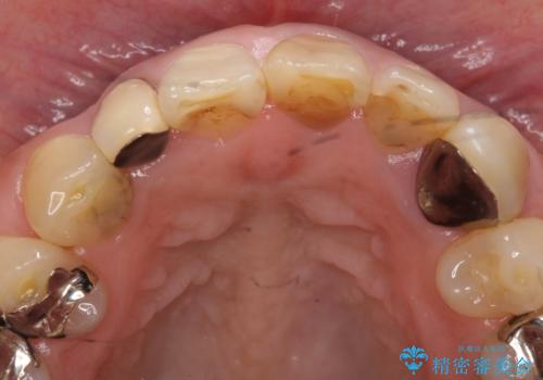 オールセラミッククラウン 下がってしまった前歯の歯茎の改善の治療前