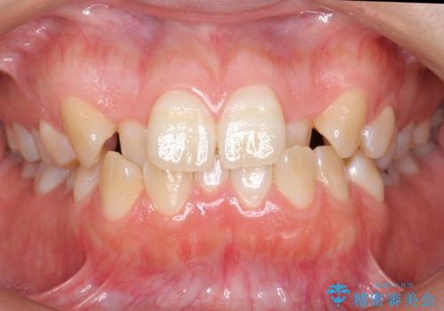 よくある悩み 前歯が裏に2本入っているのを治したいの症例 治療前