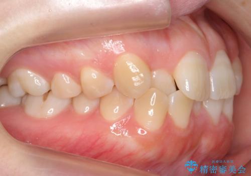 よくある悩み 前歯が裏に2本入っているのを治したいの治療前