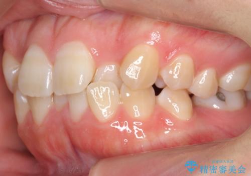 よくある悩み 前歯が裏に2本入っているのを治したいの治療前