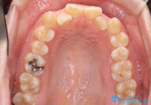 よくある悩み 前歯が裏に2本入っているのを治したいの治療前