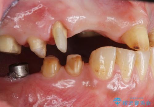 痛くて噛めない インプラントで全て治療したいの治療中