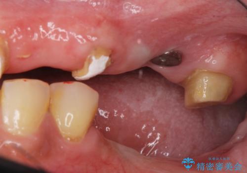 痛くて噛めない インプラントで全て治療したいの治療中