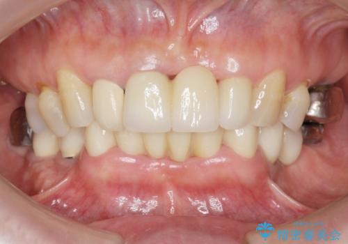 前歯が抜けそう ブリッジできれいに 70代女性の治療後