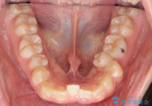 よくある悩み 前歯が裏に2本入っているのを治したいの治療前
