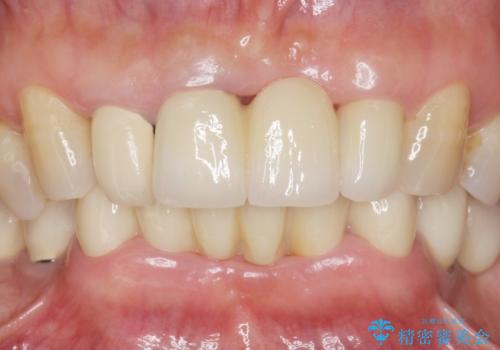 前歯が抜けそう ブリッジできれいに 70代女性の治療後