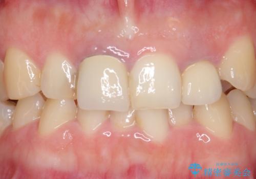 オールセラミッククラウン(スペシャル) 前歯を綺麗にの治療前