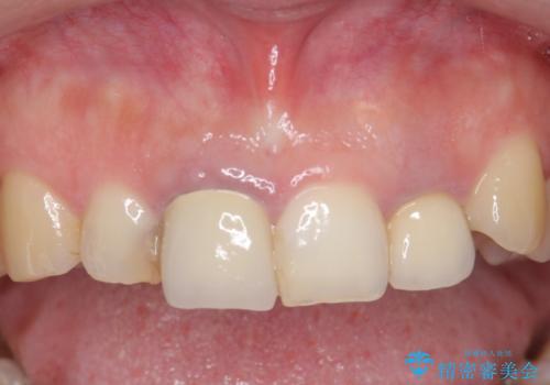 オールセラミッククラウン(スペシャル) 前歯を綺麗にの治療前
