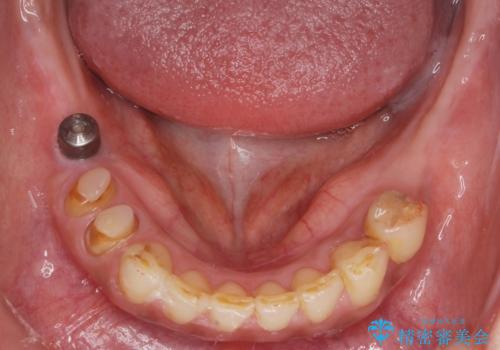 痛くて噛めない インプラントで全て治療したいの治療中
