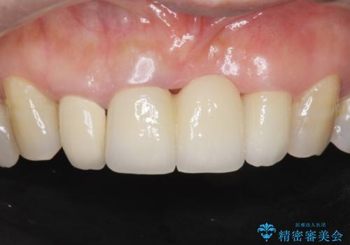 前歯が抜けそう ブリッジできれいに 70代女性の治療後