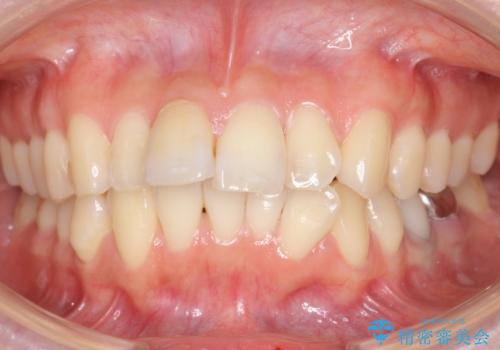 「整形した?」と言われるほどの変化! 口元を矯正治療で改善 鼻を高くしたわけでも、アゴに何か入れたわけでもありません。の症例 治療前