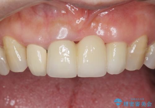 前歯が抜けそう ブリッジできれいに 70代女性の治療後