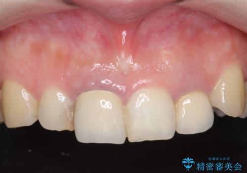 オールセラミッククラウン(スペシャル) 前歯を綺麗にの治療前