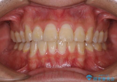 定期健診で歯のクリーニング　PMTCの治療前