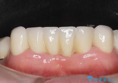 前歯が抜けそう ブリッジできれいに 70代女性の治療後