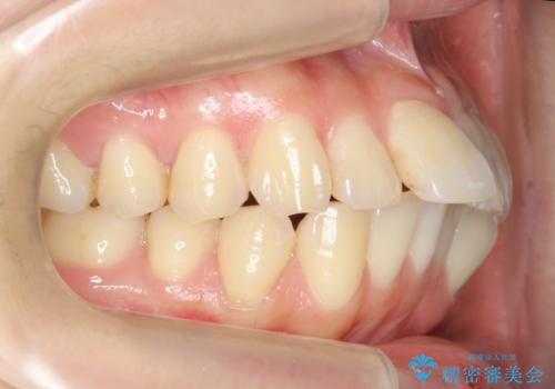 「整形した?」と言われるほどの変化! 口元を矯正治療で改善 鼻を高くしたわけでも、アゴに何か入れたわけでもありません。