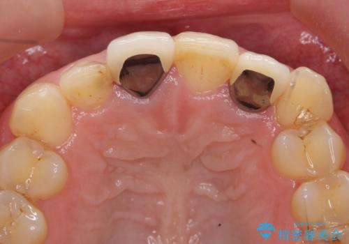 オールセラミッククラウン(スペシャル) 前歯を綺麗にの治療前