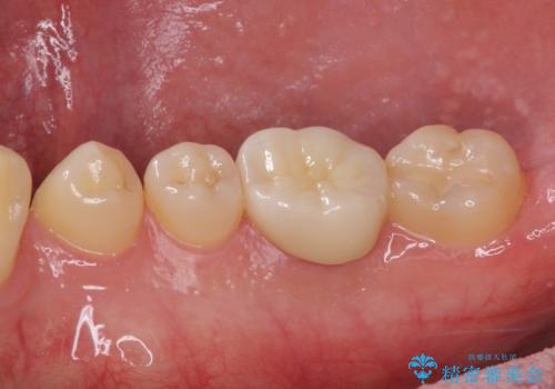 奥歯の目立つ銀歯が気になる　奥歯のセラミッククラウンの治療後