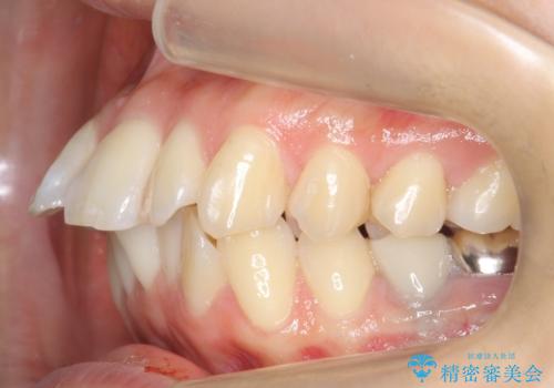 「整形した?」と言われるほどの変化! 口元を矯正治療で改善 鼻を高くしたわけでも、アゴに何か入れたわけでもありません。の治療前