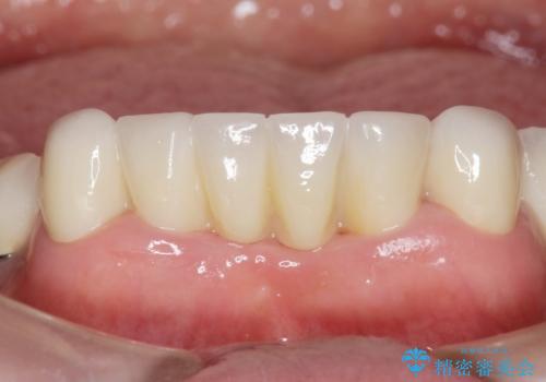 前歯が抜けそう ブリッジできれいに 70代女性の治療後