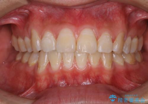 定期健診で歯のクリーニング PMTCの治療後