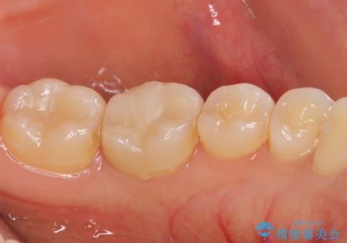 奥歯が痛い 根管治療とオールセラミッククラウンの治療前