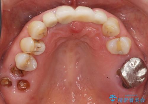 前歯が抜けそう ブリッジできれいに 70代女性の治療後