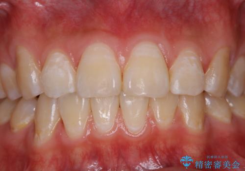 定期健診で歯のクリーニング PMTCの治療後