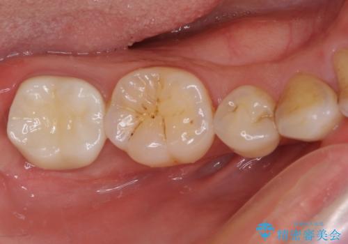 根管治療後の補綴治療 奥歯のセラミッククラウンの治療後