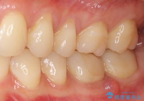 奥歯が痛い 根管治療とオールセラミッククラウンの治療前