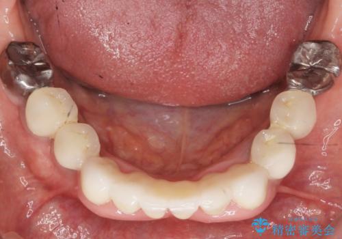前歯が抜けそう ブリッジできれいに 70代女性の治療後