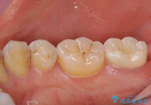 根管治療後の補綴治療 奥歯のセラミッククラウンの治療後