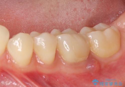 奥歯が痛い 根管治療とオールセラミッククラウンの治療前