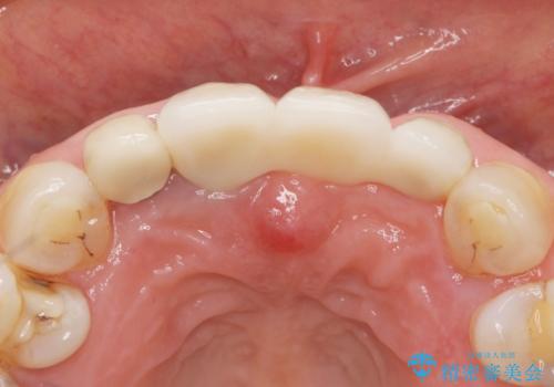 前歯が抜けそう ブリッジできれいに 70代女性の治療後