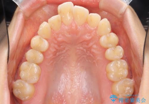 「整形した?」と言われるほどの変化! 口元を矯正治療で改善 鼻を高くしたわけでも、アゴに何か入れたわけでもありません。の治療前