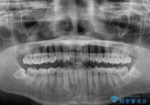 短期間で治療したい　目立たないワイヤー装置での非抜歯矯正の治療前