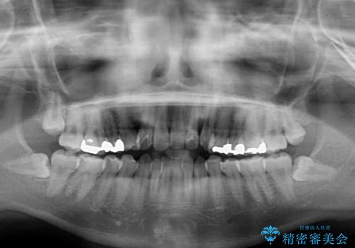 後戻りを治したい 骨格的なズレの大きい方のインビザライン矯正の治療前