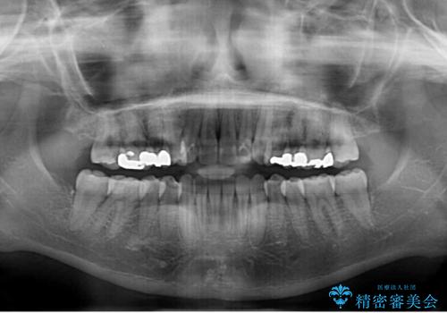 後戻りを治したい 骨格的なズレの大きい方のインビザライン矯正の治療後