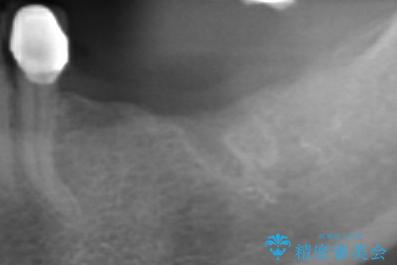 入れ歯で食事が楽しくなくなった。インプラントでまたしっかりとかみたいの治療前