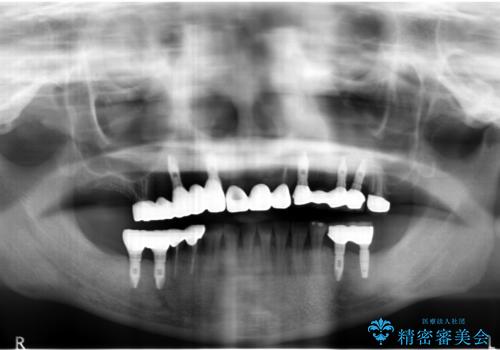 痛くて噛めない インプラントで全て治療したいの治療後