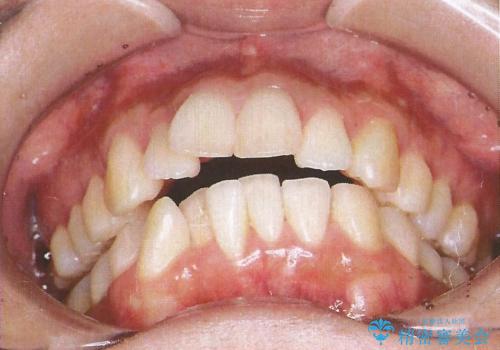 裏側装置で出っ歯の矯正治療の治療前