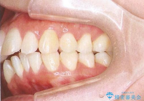 裏側装置で出っ歯の矯正治療の治療前