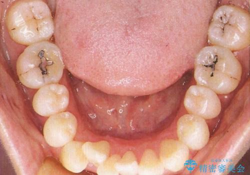 裏側装置で出っ歯の矯正治療の治療前