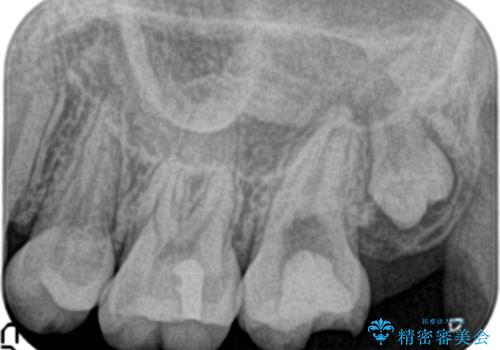 奥歯が痛い。ラバーダム使った治療がしたい。の治療前