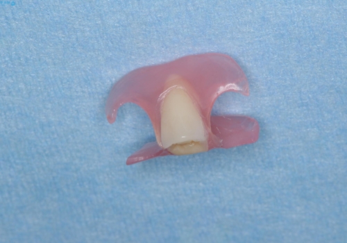 [目立たない入れ歯] ノンクラスプデンチャー   バルプラストの治療中