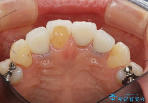 歯ぐきの黒ずみ クラウンやりかえによる改善の治療後