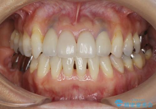 歯ぐきの黒ずみ クラウンやりかえによる改善の治療後