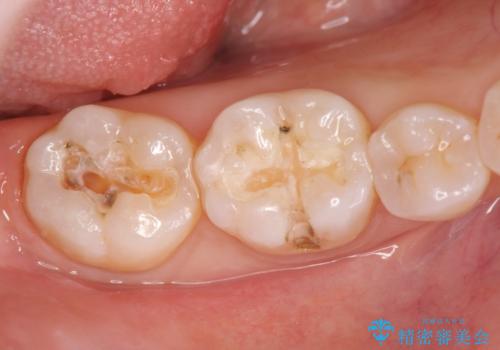 精密かつ審美的なセラミックインレーの治療中